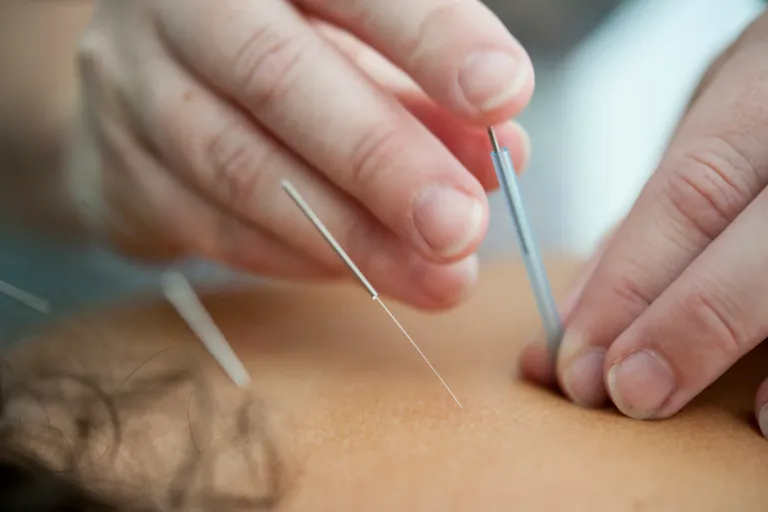 Ako dlho trvá akupunktúra a čo sa ňou dá liečiť?